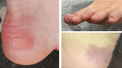 Атлас поражений кожи при COVID-19